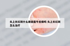 頭上長紅斑什么原因是牛皮癬嗎 頭上長紅斑怎么治療