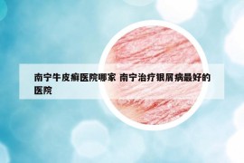 南寧牛皮癬醫(yī)院哪家 南寧治療銀屑病最好的醫(yī)院