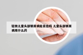 輕微兒童頭部銀屑病能自愈嗎 兒童頭部銀屑病用什么藥