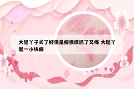 大腿丫子長(zhǎng)了好像是癬很癢抓了又痛 大腿丫起一小塊癬