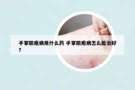 手掌膿皰病用什么藥 手掌膿皰病怎么能治好?