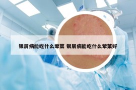 銀屑病能吃什么葷菜 銀屑病能吃什么葷菜好