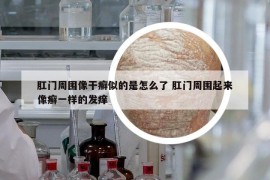 肛門周圍像干癬似的是怎么了 肛門周圍起來像癬一樣的發(fā)癢