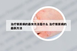 治療銀屑病的最快方法是什么 治療銀屑病的最新方法
