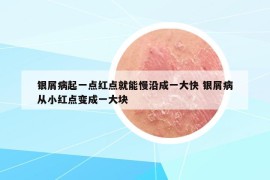 銀屑病起一點紅點就能慢沿成一大快 銀屑病從小紅點變成一大塊