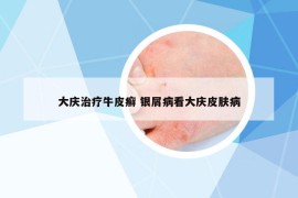 大慶治療牛皮癬 銀屑病看大慶皮膚病