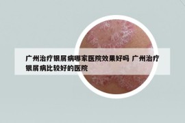 廣州治療銀屑病哪家醫(yī)院效果好嗎 廣州治療銀屑病比較好的醫(yī)院