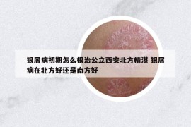 銀屑病初期怎么根治公立西安北方精湛 銀屑病在北方好還是南方好