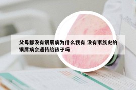 父母都沒有銀屑病為什么我有 沒有家族史的銀屑病會遺傳給孩子嗎