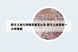 脖子上有幾塊硬皮癬怎么辦 脖子上皮膚有一小塊像癬