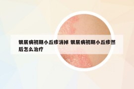 銀屑病初期小丘疹消掉 銀屑病初期小丘疹然后怎么治療