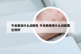 牛皮癬涂什么潤(rùn)膚乳 牛皮膚癬用什么潤(rùn)膚霜比較好