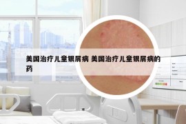 美國治療兒童銀屑病 美國治療兒童銀屑病的藥