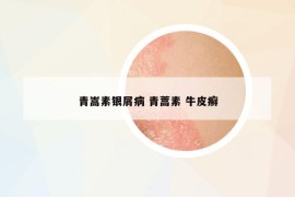 青嵩素銀屑病 青蒿素 牛皮癬