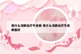 用什么泡腳治療牛皮癬 用什么泡腳治療牛皮癬最好