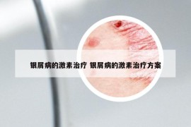 銀屑病的激素治療 銀屑病的激素治療方案