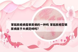 掌跖膿皰病是銀屑病的一種嗎 掌跖膿皰型銀屑病屬于大病范疇嗎?