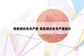 銀屑病會(huì)有多嚴(yán)重 銀屑病會(huì)有多嚴(yán)重圖片