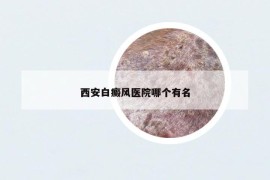 西安白癜風(fēng)醫(yī)院哪個(gè)有名
