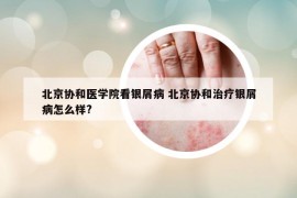 北京協(xié)和醫(yī)學(xué)院看銀屑病 北京協(xié)和治療銀屑病怎么樣?