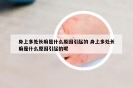身上多處長癬是什么原因引起的 身上多處長癬是什么原因引起的呢