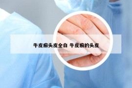 牛皮癬頭皮全白 牛皮癬的頭皮