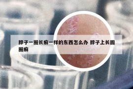 脖子一圈長癬一樣的東西怎么辦 脖子上長圓圈癬
