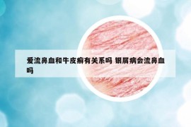 愛流鼻血和牛皮癬有關(guān)系嗎 銀屑病會(huì)流鼻血嗎