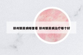 鄭州銀屑病哪里看 鄭州銀屑病治療哪個(gè)好