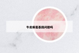 牛皮癬是基因問(wèn)題嗎