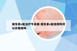 維生素e能治療牛皮癬 維生素e能祛斑嗎可以長(zhǎng)期用嗎