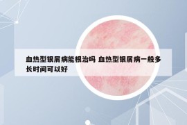 血熱型銀屑病能根治嗎 血熱型銀屑病一般多長(zhǎng)時(shí)間可以好