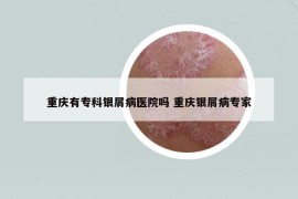 重慶有?？沏y屑病醫(yī)院嗎 重慶銀屑病專家