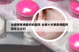 全國(guó)銀屑病最好的醫(yī)院 全國(guó)十大銀屑病醫(yī)院排名公立們