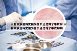 沒有家族遺傳史但為什么還是得了牛皮癬 沒有家族遺傳史但為什么還是得了牛皮癬病