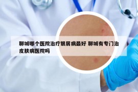 聊城哪個醫(yī)院治療銀屑病最好 聊城有專門治皮膚病醫(yī)院嗎