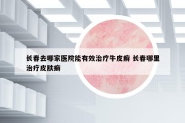 長春去哪家醫(yī)院能有效治療牛皮癬 長春哪里治療皮膚癬
