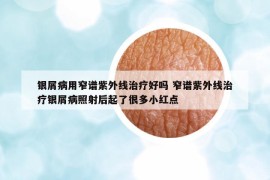 銀屑病用窄譜紫外線治療好嗎 窄譜紫外線治療銀屑病照射后起了很多小紅點(diǎn)