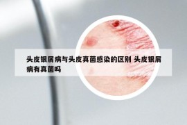 頭皮銀屑病與頭皮真菌感染的區(qū)別 頭皮銀屑病有真菌嗎