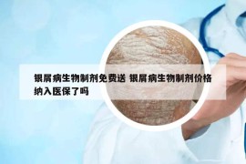 銀屑病生物制劑免費送 銀屑病生物制劑價格納入醫(yī)保了嗎