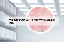 牛皮癬性生活傳染不 牛皮癬性生活傳染不傳染嗎