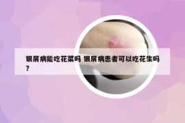 銀屑病能吃花菜嗎 銀屑病患者可以吃花生嗎?