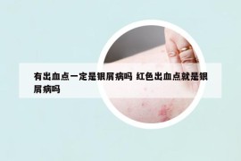 有出血點一定是銀屑病嗎 紅色出血點就是銀屑病嗎