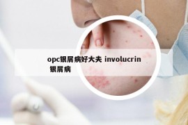 opc銀屑病好大夫 involucrin 銀屑病