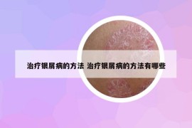 治療銀屑病的方法 治療銀屑病的方法有哪些