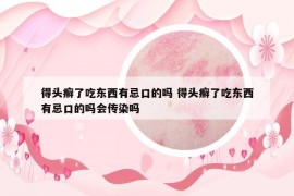 得頭癬了吃東西有忌口的嗎 得頭癬了吃東西有忌口的嗎會(huì)傳染嗎