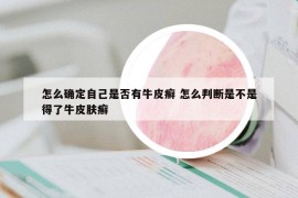 怎么確定自己是否有牛皮癬 怎么判斷是不是得了牛皮膚癬