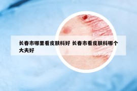 長春市哪里看皮膚科好 長春市看皮膚科哪個大夫好