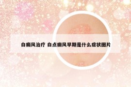 白癜風(fēng)治療 白點(diǎn)癲風(fēng)早期是什么癥狀圖片