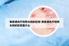 銀屑病光療和照太陽的區(qū)別 銀屑病光療和照太陽的區(qū)別是什么